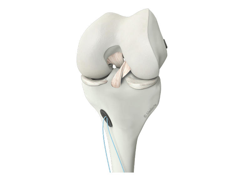 M-ARS ACL implants